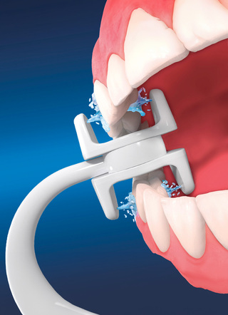 Extra opzetstukken voor Corp Care Miracle Smile monddouche