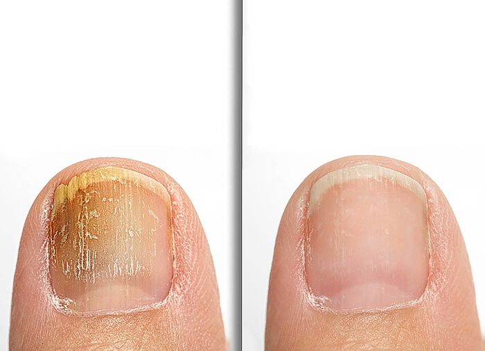 Anti-voet- en nagelschimmelspray 