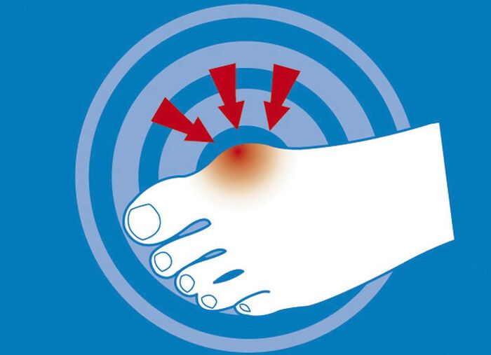 epitact Epithelium 26® Hallux valgusbescherming HUIDKLEURIG