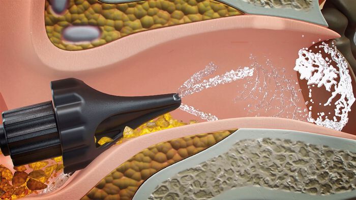 Elektrische oordouche 